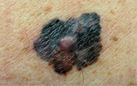 Mole colour variation example2