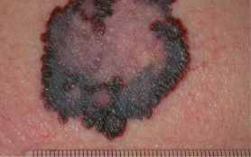 Mole border irregularity example3