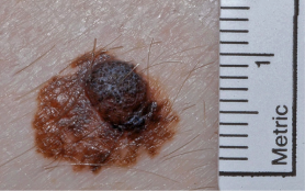 Mole diameter example2